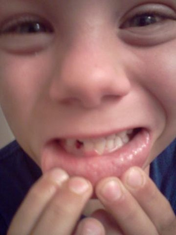Cj Missing tooth 081511.jpg - Created on: 5/2/2012 2:40:36 PM
